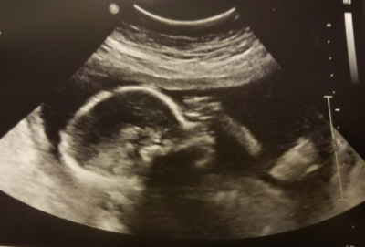 Abortion and the Disabled: Two Hot Takes